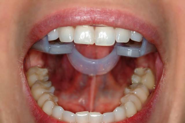 Bruxism Cure - Lingual Ring front